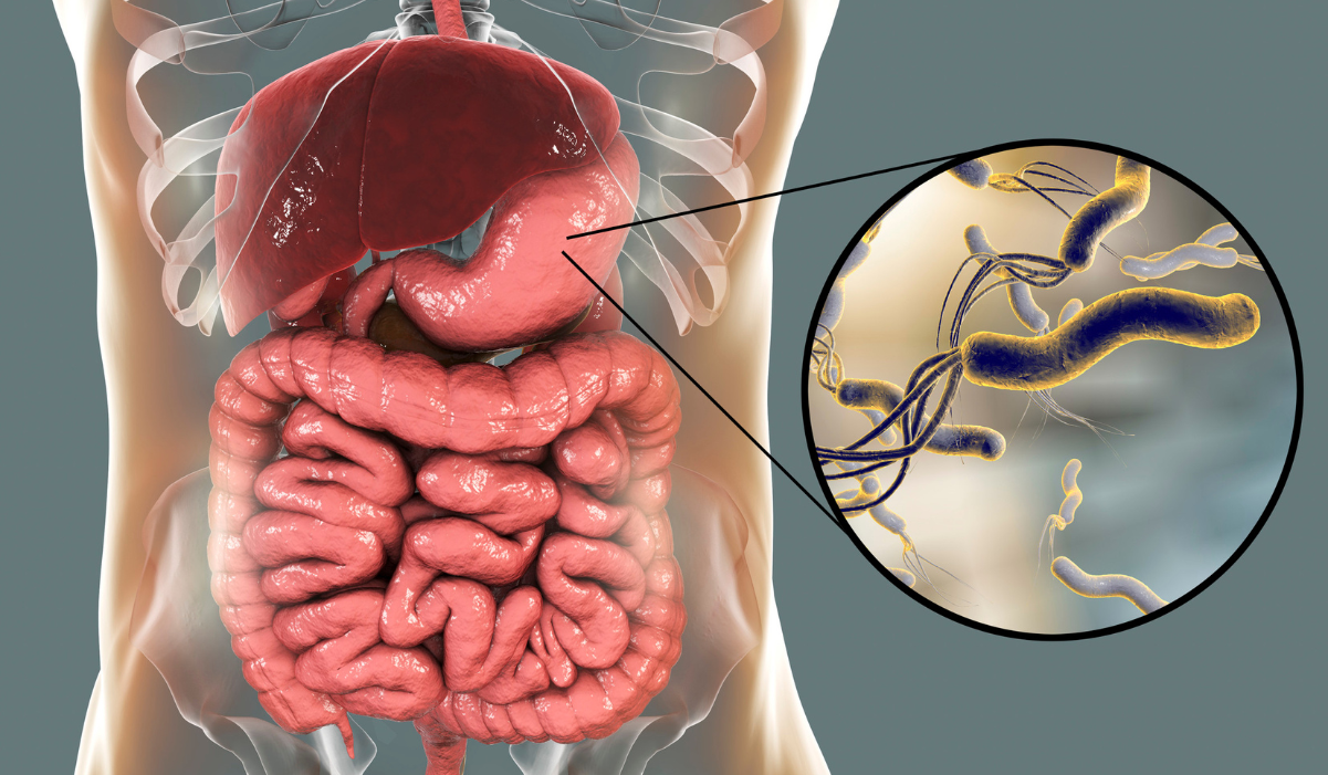 Helicobacter pylori – az egyik leggyakoribb baktériumfertőzés